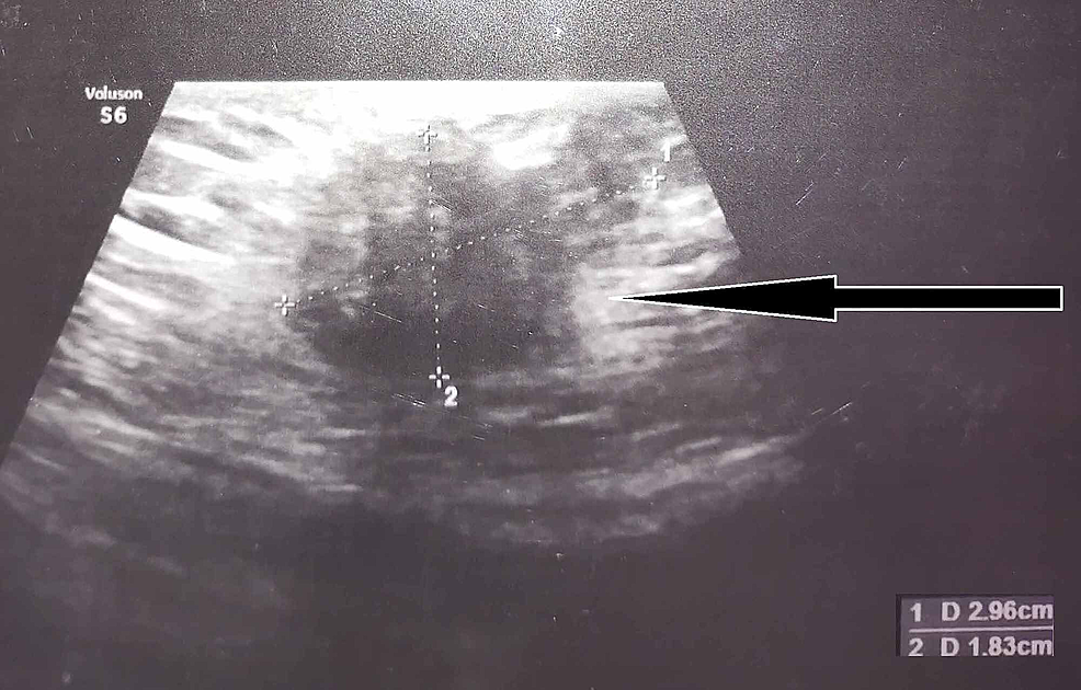 Cureus Endometriosis at Cesarean Scar Presenting As an Acute Abdomen