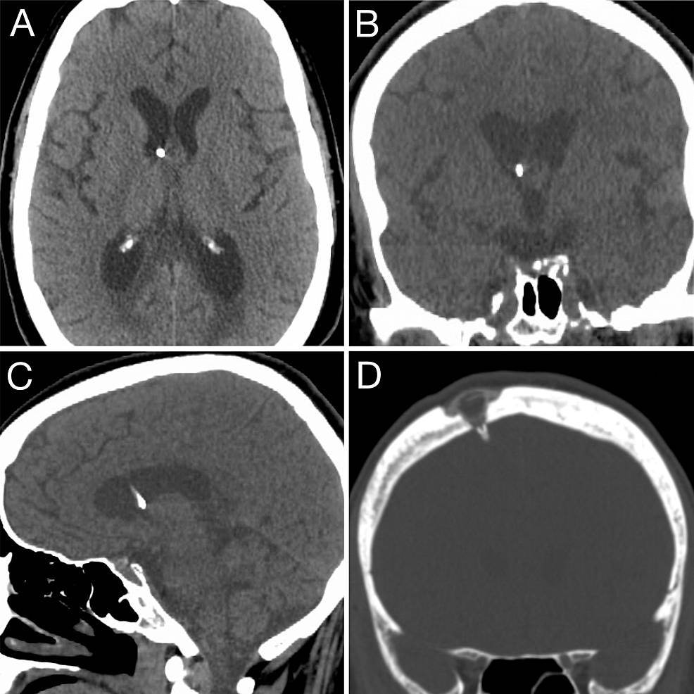 Cureus Ommaya Reservoir Insertion A Technical Note