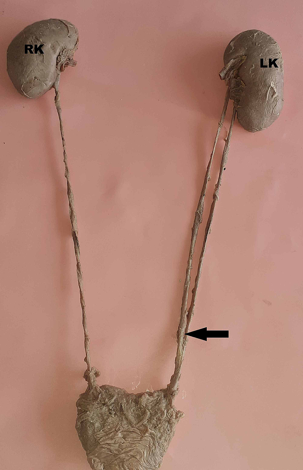 cureus-double-ureter-incidence-types-and-its-applied-significance