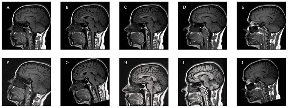 Use of Synthetic Intelligence within the Prediction of Chiari Malformation Type 1 Recurrence After Posterior Fossa Decompressive Surgical therapy