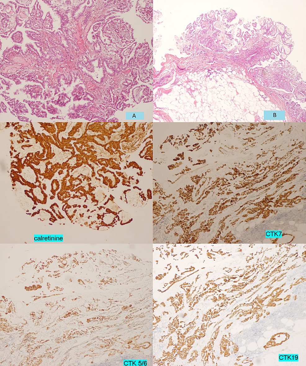 Histologic-appearance-(A,-B)-and-immunocytochemical-analyses-of--well-differentiated-papillary-mesothelioma-of-the-peritoneum.