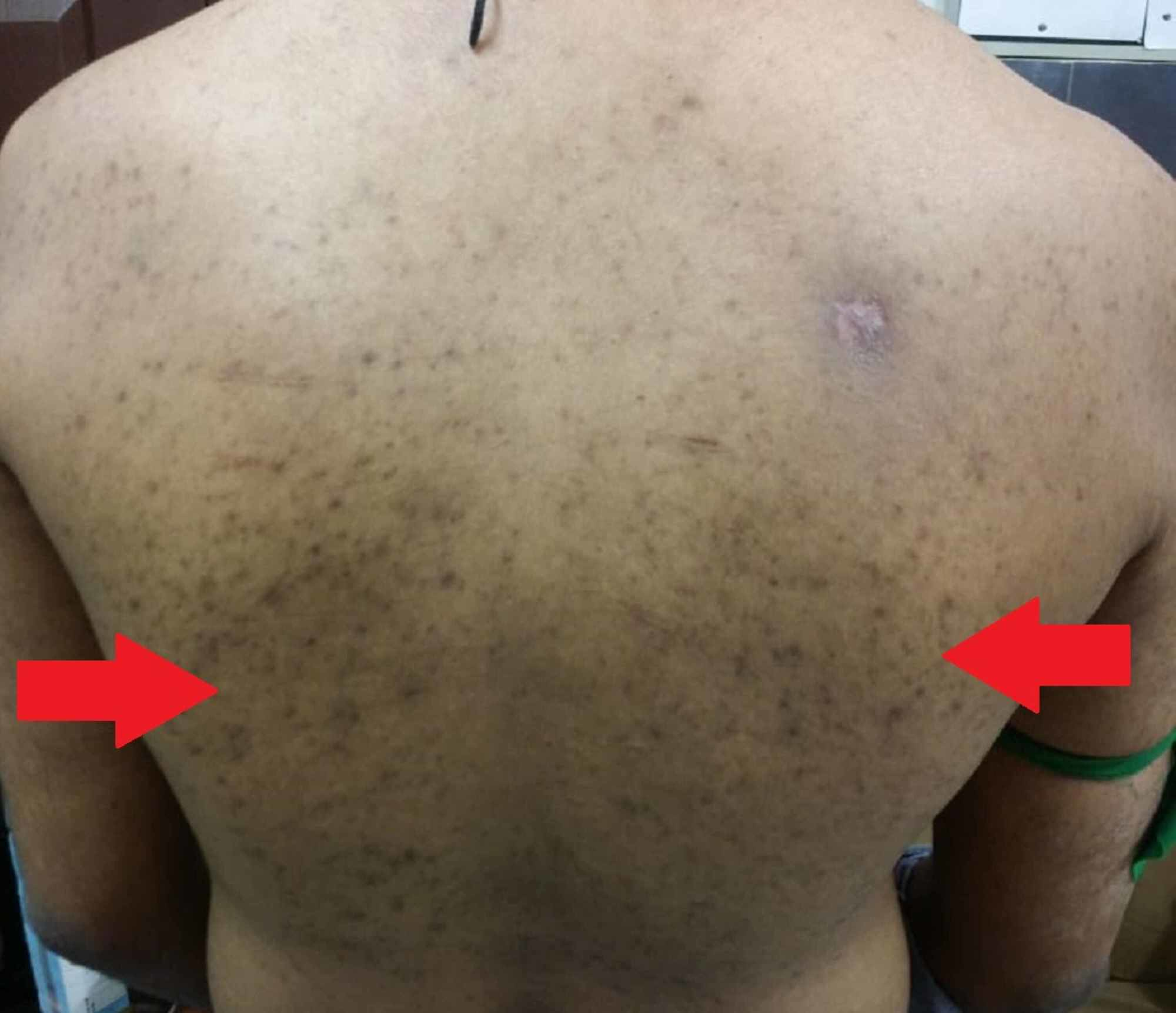 Cureus | Young-onset Amyotrophic Lateral Sclerosis with Rare Skin Manifestation: Case Report and Literature