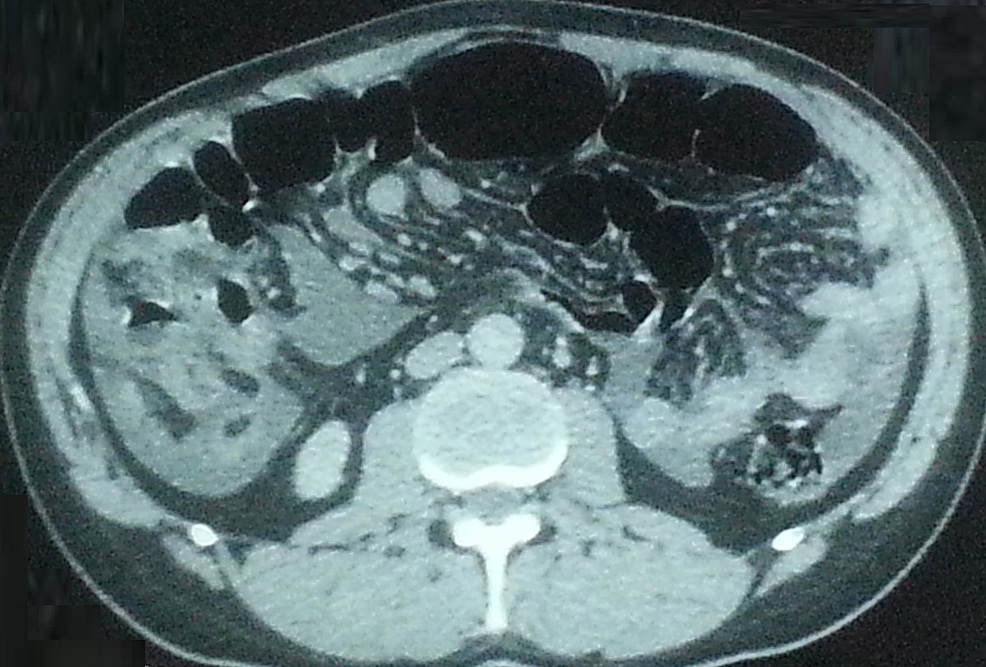 Complete-regression-of-both-the-ascites-and-the-peritoneal-micronodules-in-computed-tomography-of-the-abdomen.