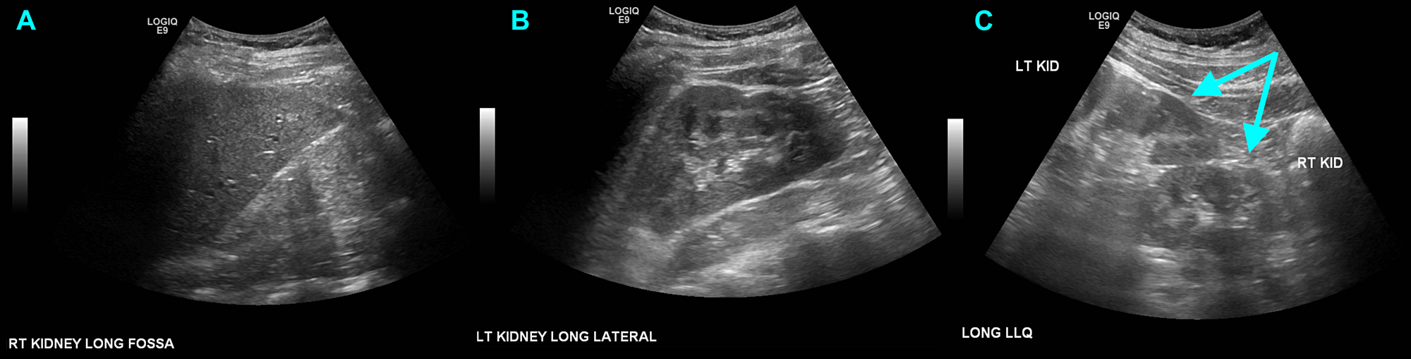 Cureus Crossed Renal Ectopia with a Fused Supernumerary Kidney