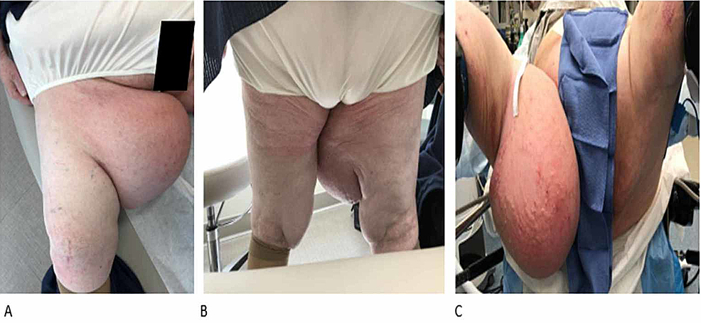 Cureus, Exophytic Adiposis Dolorosa (Dercum's Disease) of the Thigh: A Case  Report