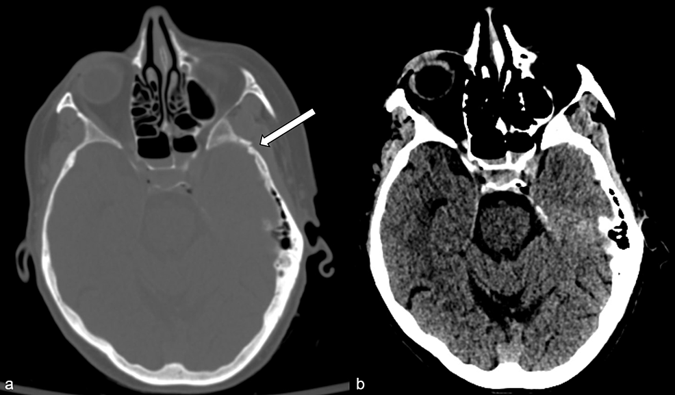 Computerized-tomography-demonstrates-soft-tissue-contusion-and-skull-fracture-(a,-arrow)-but-no-intracranial-hemorrhage-(b).-