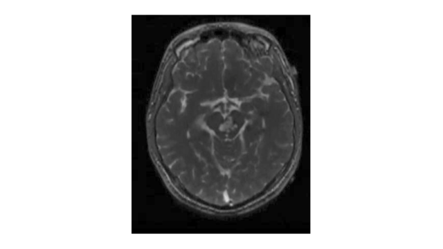 Preoperative-MRI-of-case-illustration.