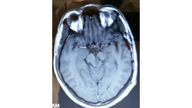 -Postoperative-MRI-of-case-illustration.