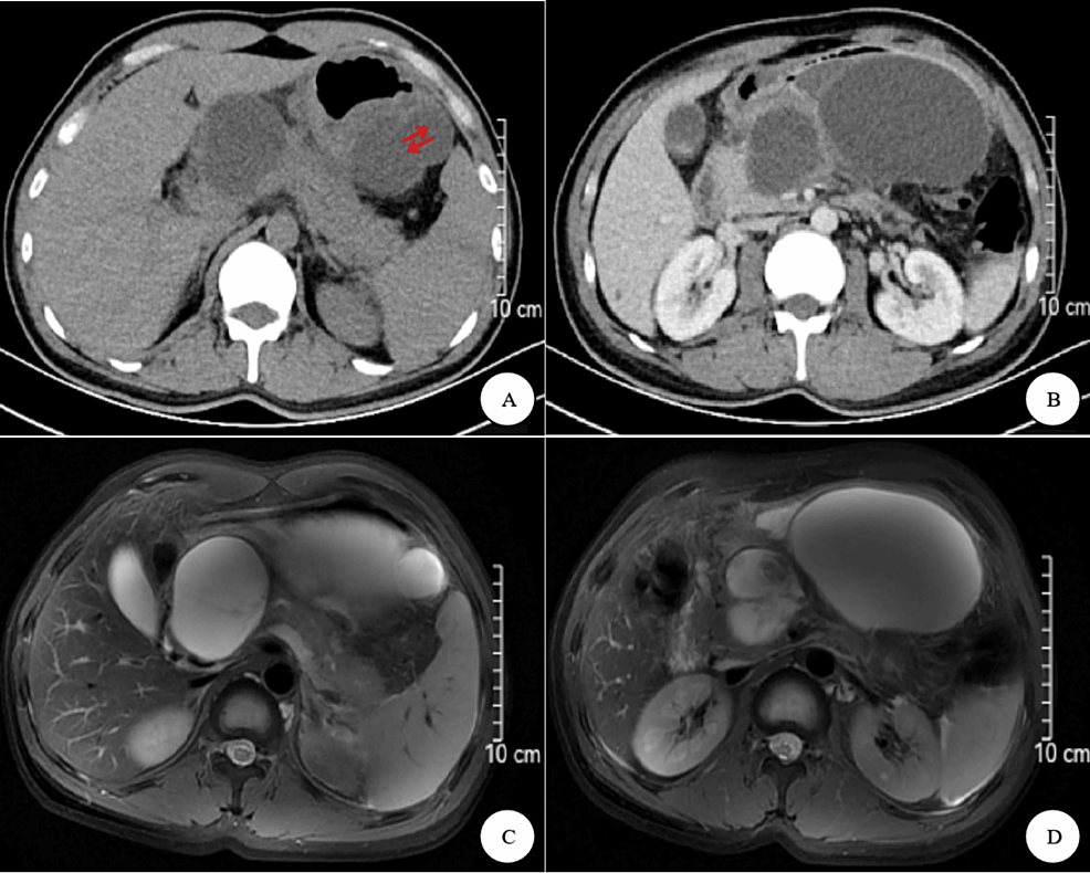 Endoscopic Combined Drainage of One Giant and Multiple Small Pancreatic ...