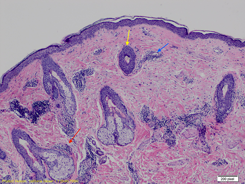 Cureus | Tumid Lupus Erythematosus and Systemic Lupus Erythematosus: A ...