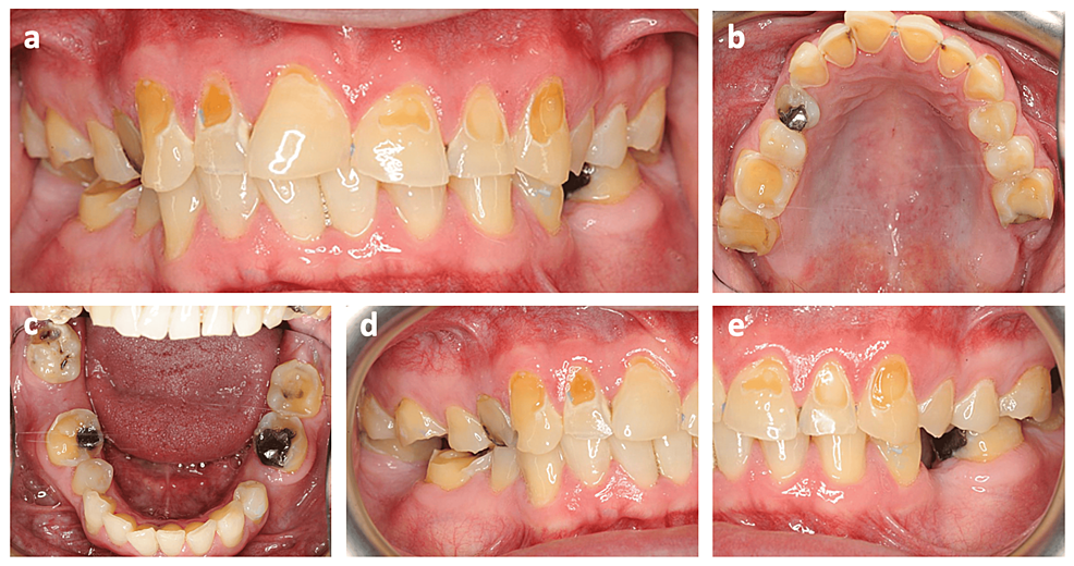 A Full Mouth Rehabilitation of an AsthmaAssociated Patient With Tooth
