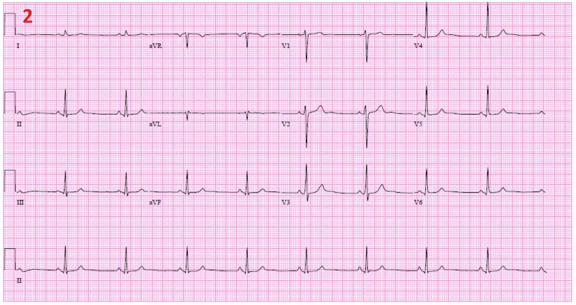 syncopal episode icd 9