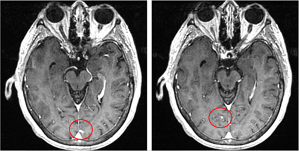 Cureus | Leptomeningeal Carcinomatosis in Recurrent Non-Small Cell Lung