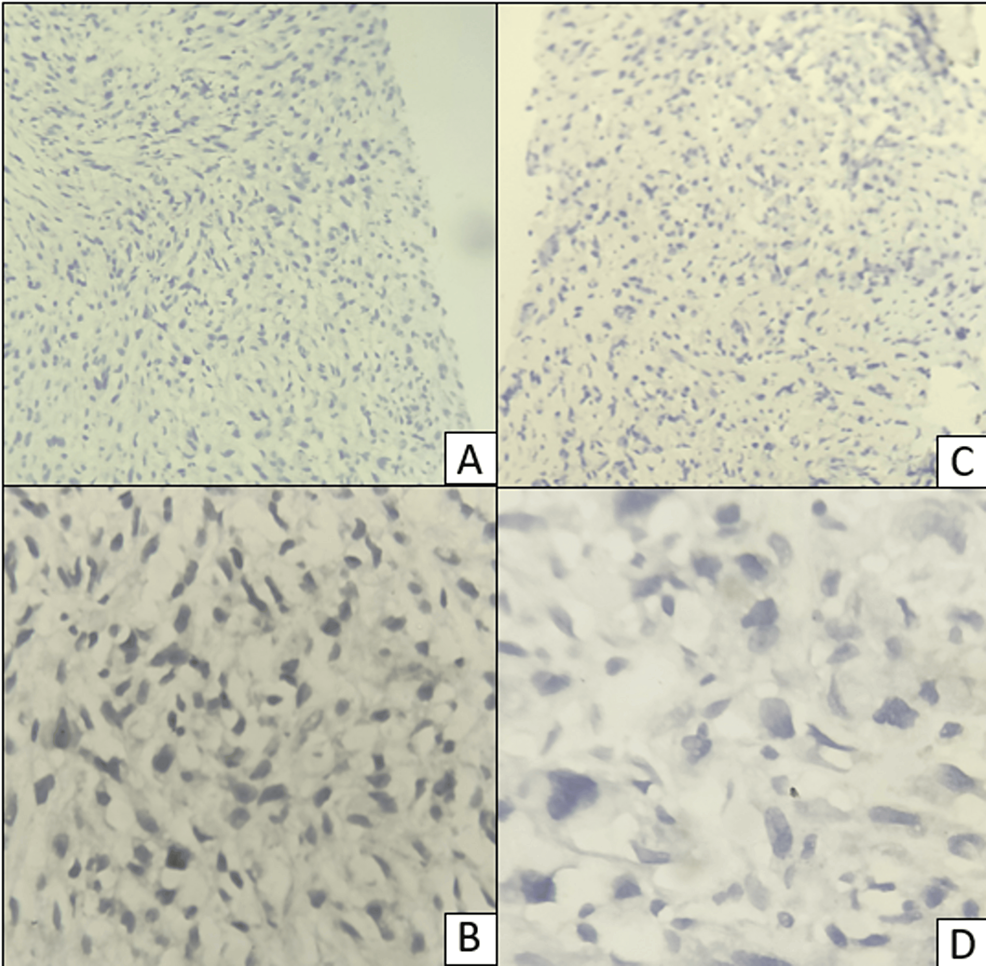 An-immunohistochemical-(IHC)-stained-section-of-the-breast-mass-showing-negative-expression-of-the-estrogen-receptor-(A-and-B)-and-progesterone-receptor-(C-and-D).-A-and-C:-×100;-B-and-D:-×400.