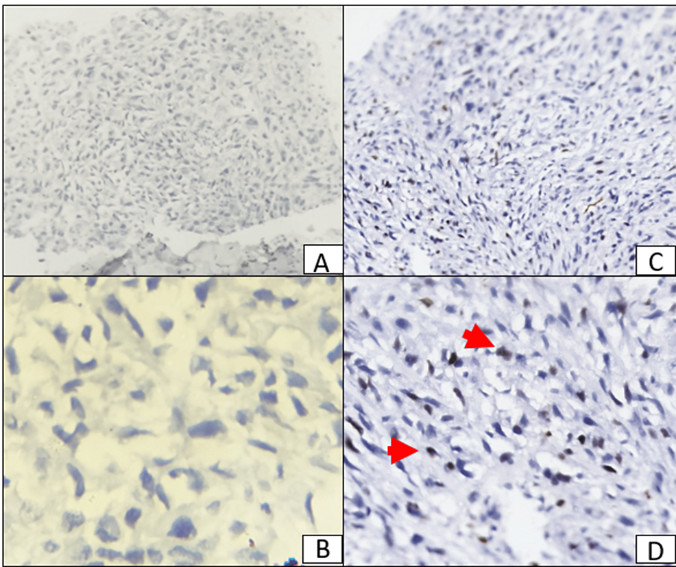 An-immunohistochemical-(IHC)-stained-section-of-the-breast-mass-showing-negative-expression-of-the-Her2neu-(A-and-B)-and-positive-expression-(red-arrows)-of-the-Ki67-in-more-than-10%-of-the-cells-(C-and-D).-A-and-C:-×100;-B-and-D:-×400.