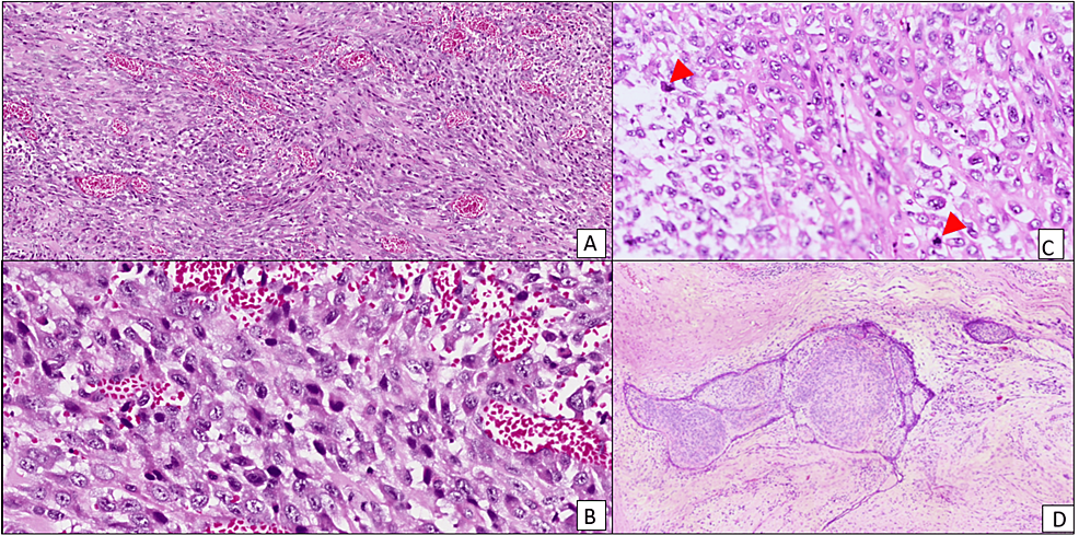 Hematoxylin-and-eosin-stained-section-of-the-breast-mass-showing-sheets-of-pleomorphic-spindled-cells-(A),-with-pleomorphic-hyperchromatic-nuclei-(B)-and-few-atypical-mitoses-(C,-red-arrows),-associated-with-hypercellular-stromal-overgrowth-(D).-A-and-D:-×100,-B-and-C:-×400.