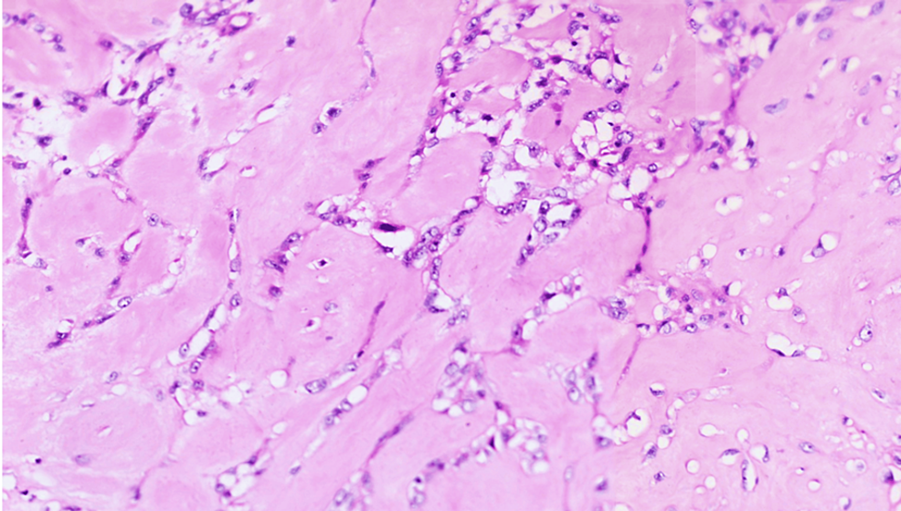 Hematoxylin-and-eosin-stained-section-of-the-breast-mass-showing-extensive-areas-of-osteoid-differentiation-(×400).
