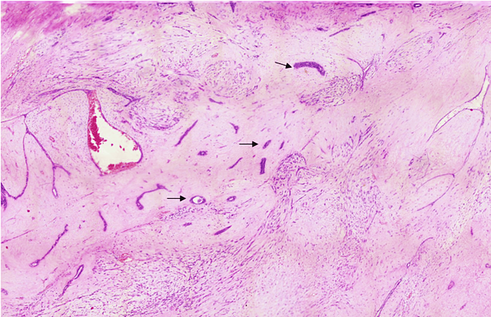 Hematoxylin-and-eosin-stained-section-of-the-breast-mass-showing-benign-ducts-(×100).