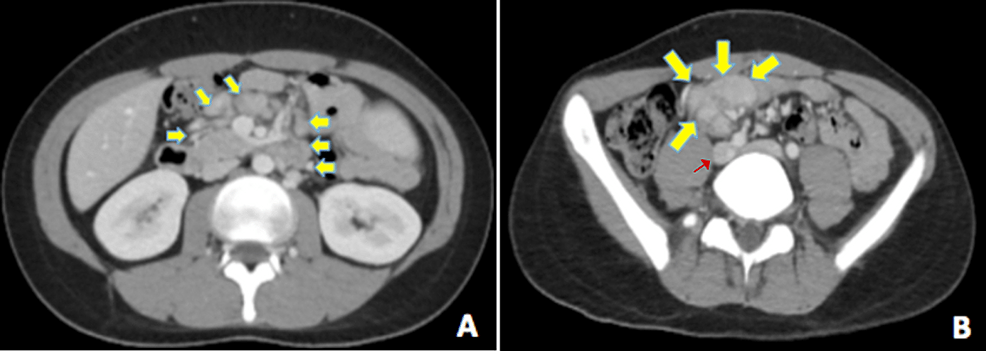 Cureus | A Case of Kikuchi-Fujimoto Disease Associated with Erosive ...