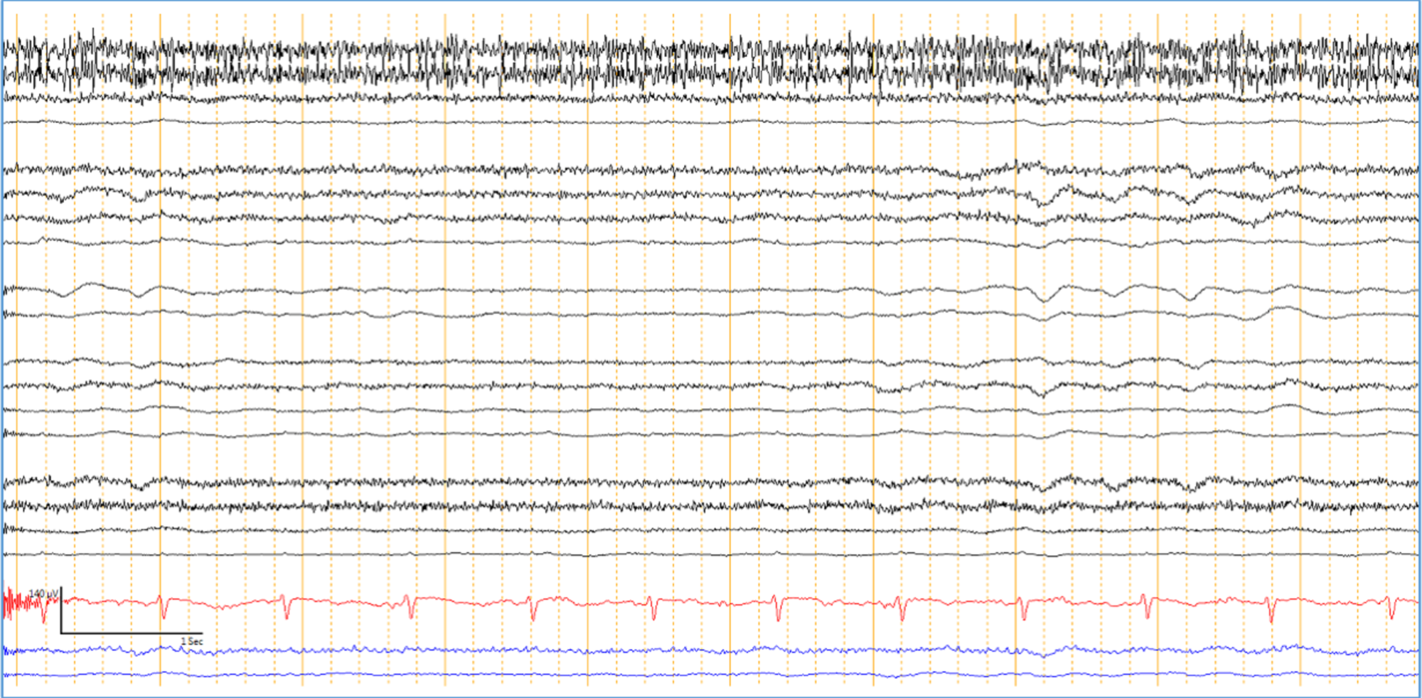 Cureus A Mysterious Case of Recurrent Acute Hyperammonemic Encephalopathy