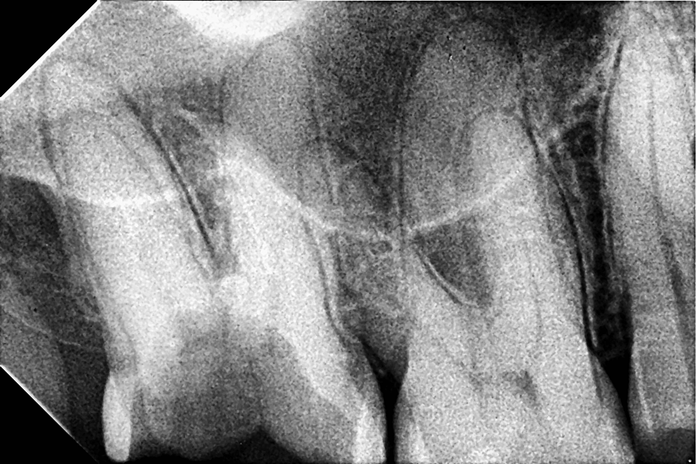 Diving Deep: Exploring Dual Palatal Canals in the Upper Second