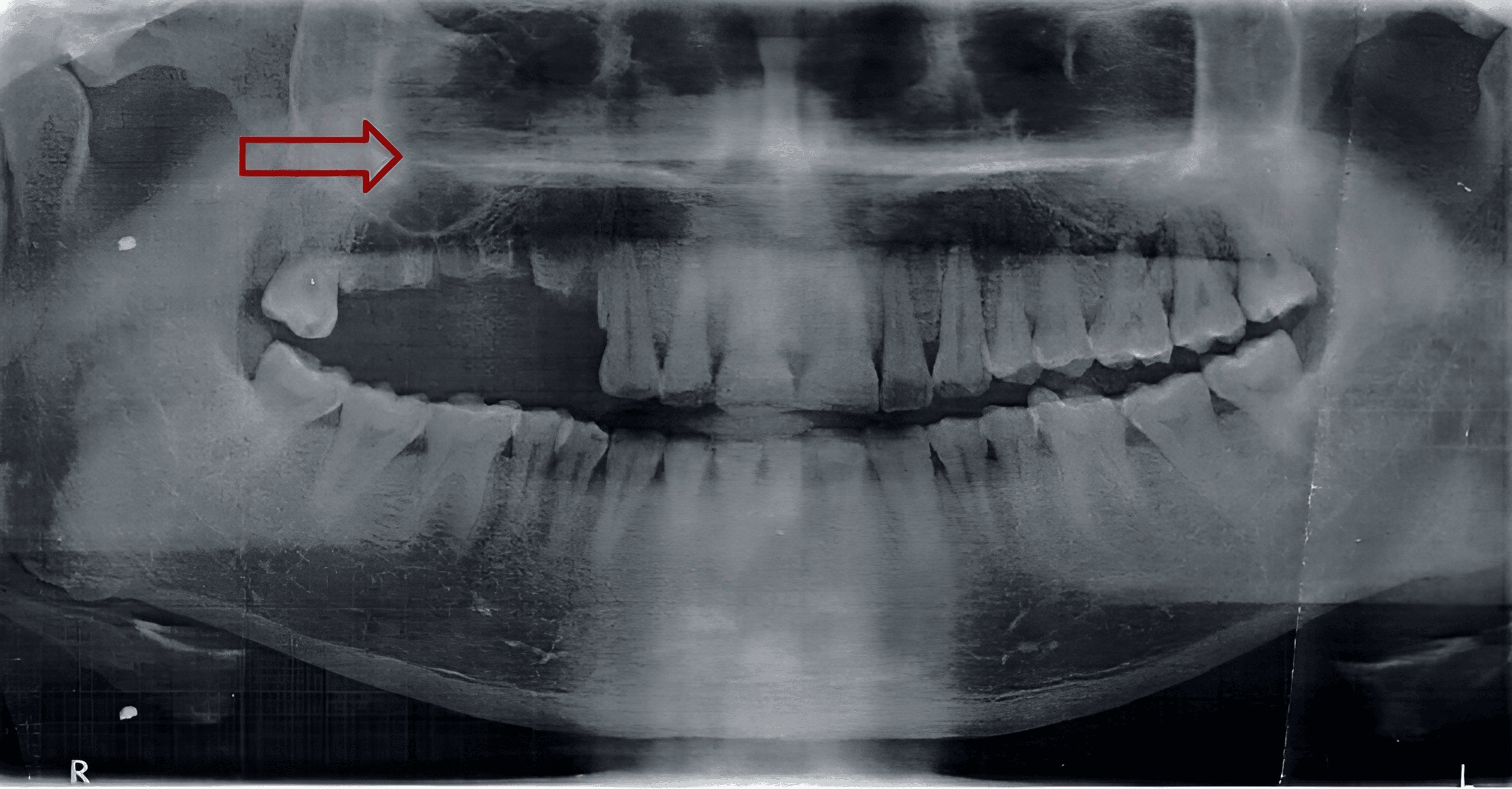 Cureus The Rarity of Maxillary Osteomyelitis Insights From a Unique