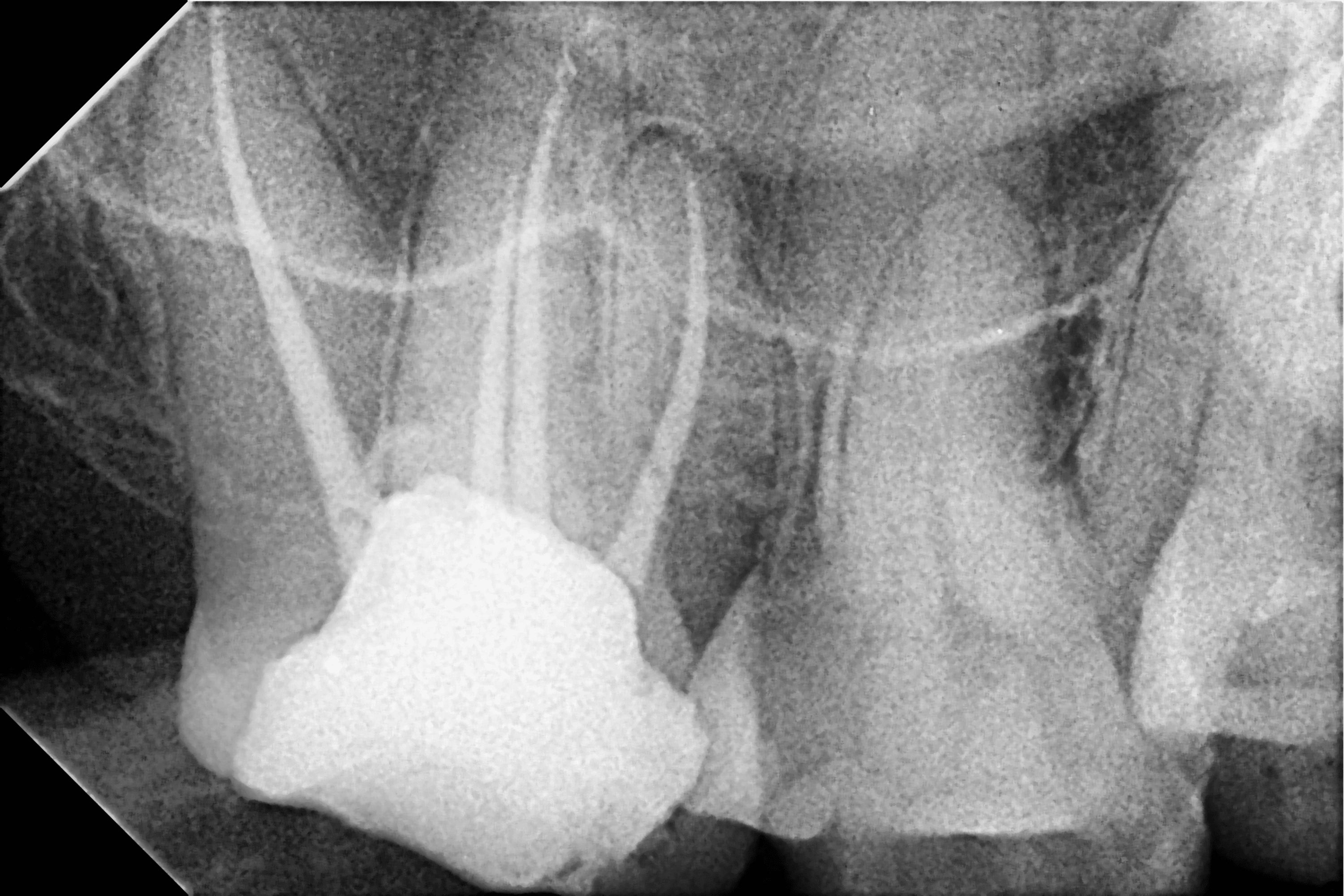 Diving Deep Exploring Dual Palatal Canals in the Upper Second Molar