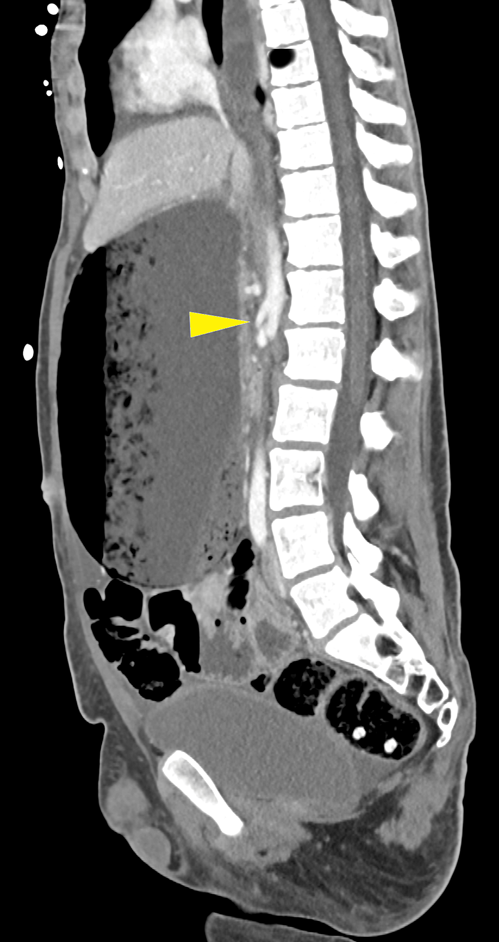 Single Anastomosis Sleeve Jejunal Bypass in Acute Mesenteric Artery ...