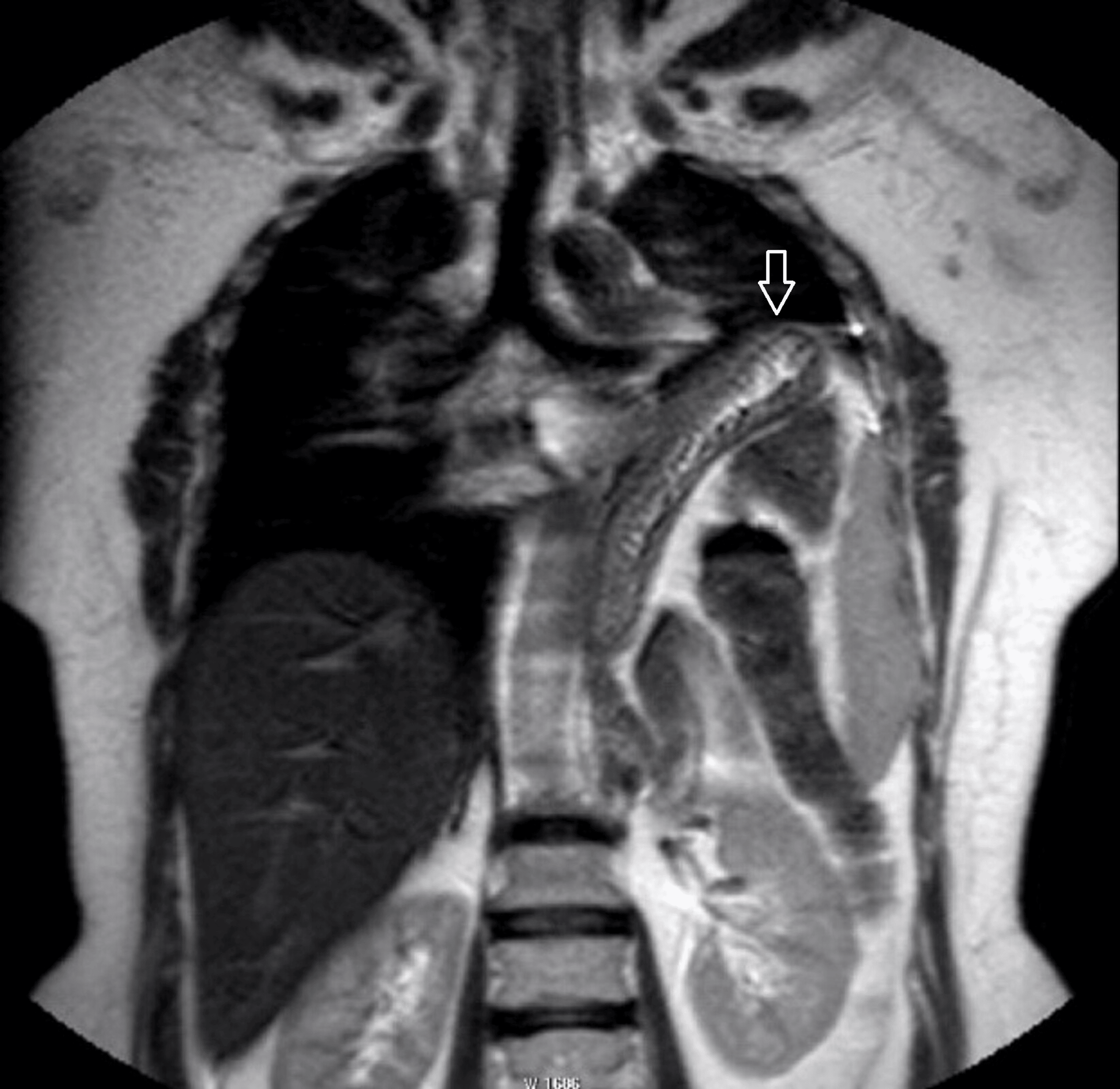 Cureus | Bi-parametric MRI of the Diaphragm Using Dynamic and Static ...