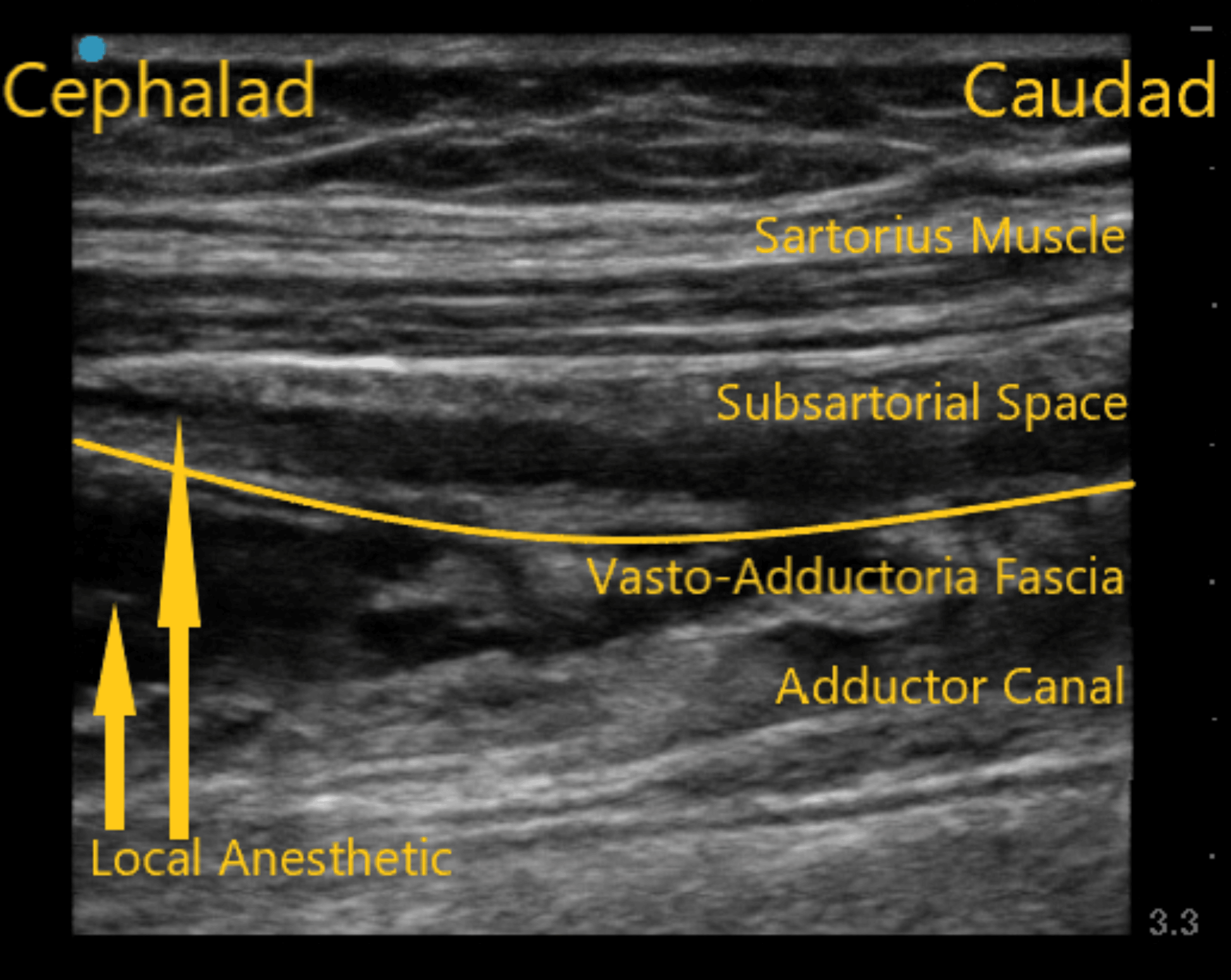 Ultrasound Evaluation of Subsartorial Spread Following Adductor Canal