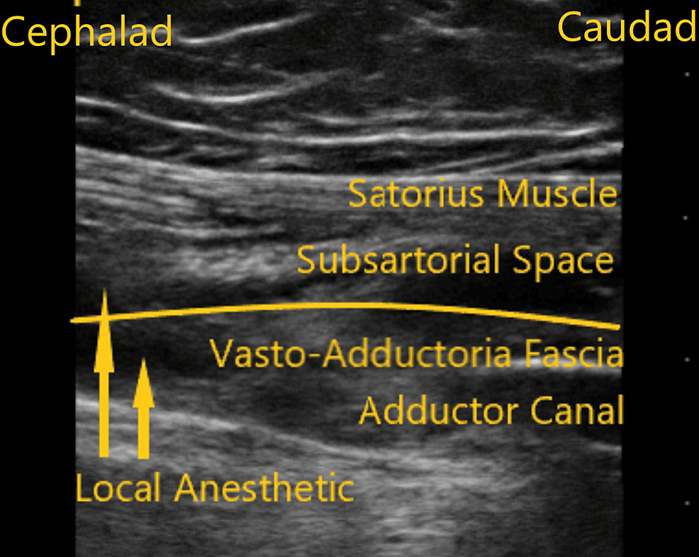 Ultrasound Evaluation of Subsartorial Spread Following Adductor Canal