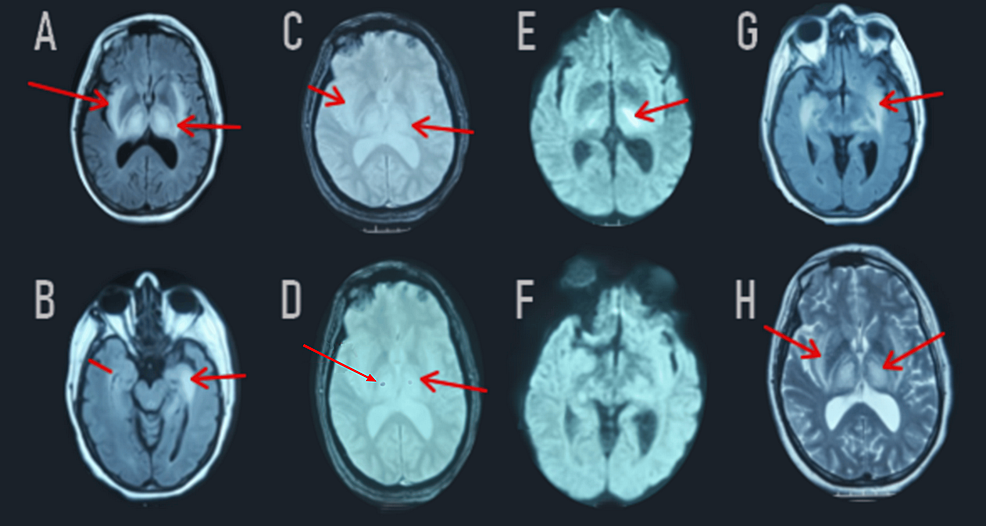 Follow-up-MRI-revealed-significant-regression-of-the-FLAIR-weighted-hypersignal-in-the-two-thalami,-the-cerebral-peduncles,-the-bulb,-the-hippocampus,-and-the-right-internal-temporal-areas-(A,-B,-G).-Diffusion-weighted-imaging-(E,-F)-showed-a-decrease-in-the-apparent-diffusion-coefficient-on-the-periphery-(red-arrow).-Post-gadolinium-images-demonstrated-contrast-enhancement-in-the-two-thalami-(not-shown).-T2*-weighted-images-(C,-D)-showed-a-stable-appearance-of-the-bilateral-thalamic-hemorrhagic-lesions-(red-arrow).