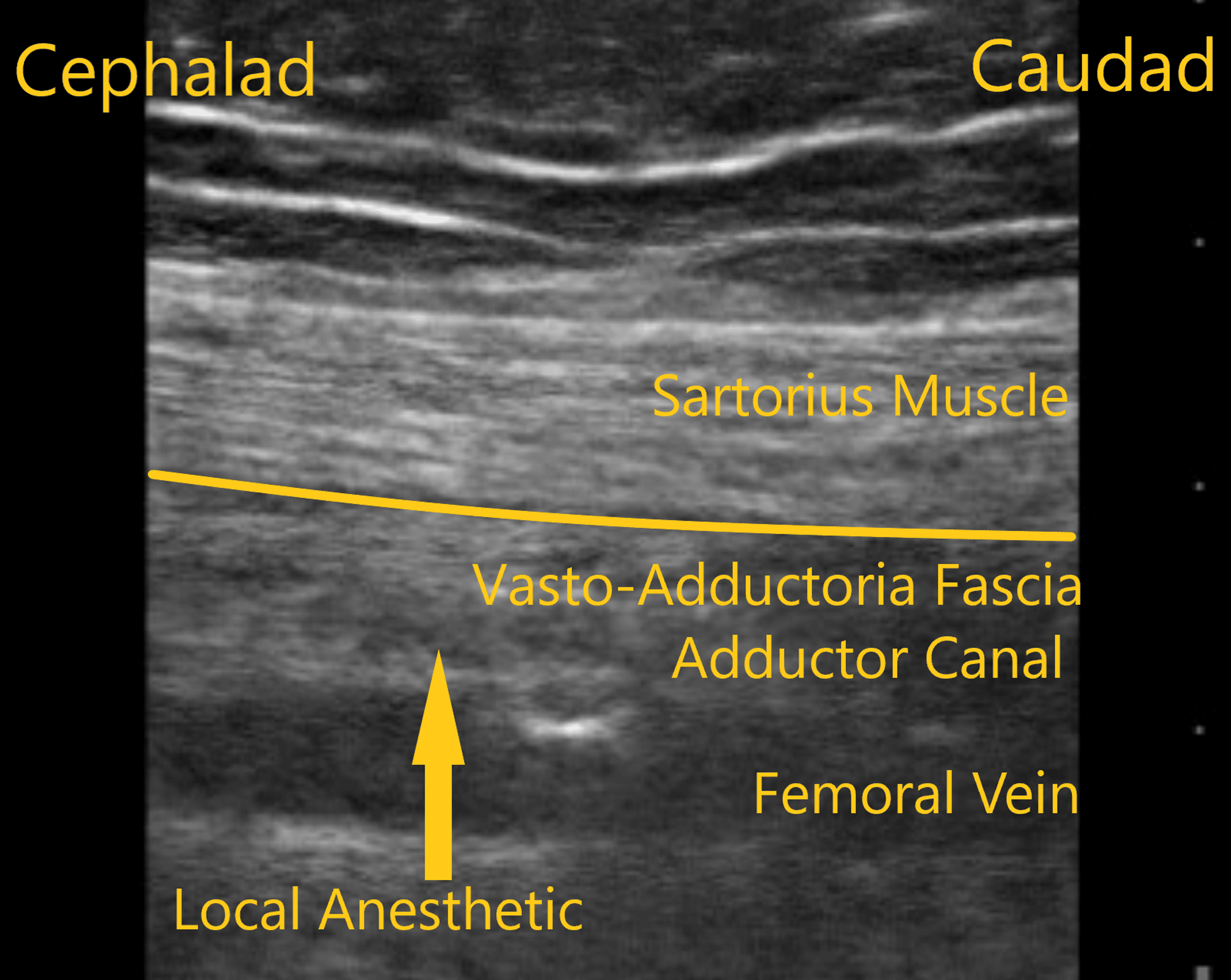 Ultrasound Evaluation of Subsartorial Spread Following Adductor Canal