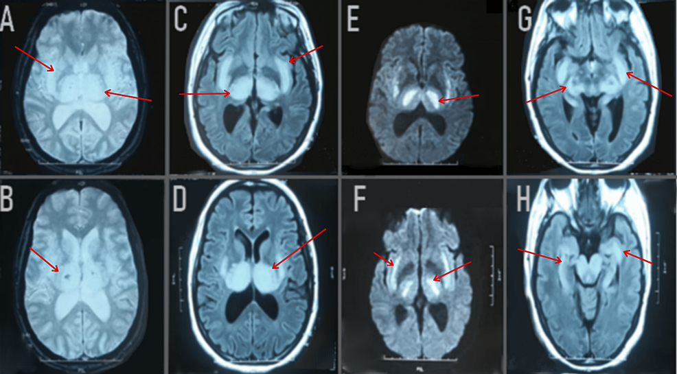 Axial-FLAIR-images-(C,-D,-G,-H)-showed-bilateral-hypersignal-abnormalities-(red-arrow)-in-the-thalamus,-posterior-limb-of-the-internal-capsule,-external-capsule,-putamen,-hypothalamus,-pons,-and-bulb.-Axial-images-with-gadolinium-demonstrated-no-abnormal-contrast-enhancement-(not-shown).-T2*-weighted-images-(A,-B)-showed-bilateral-thalamic-hemorrhagic-lesions.-Diffusion-weighted-imaging-(E,-F)-showed-a-hypersignal-B1000-with-an-apparent-diffusion-coefficient-decrease.