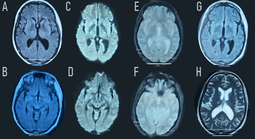 Remarkable-regression-of-the-FLAIR-weighted-(A-B-G)-and-diffusion-weighted-(C-D)-bilateral-hypersignal-in-the-thalamus.-Extinction-of-the-bilateral-signal-abnormalities-in-the-external-capsule,-posterior-limb-of-the-internal-capsule,-and-in-the-pons.-Axial-T2*-weighted-images-(E-F)-showed-bilateral-thalamic-hemorrhagic-lesions-and-in-the-posterior-part-of-the-putamen,-as-well-as-the-presence-of-minimal-intraventricular-subarachnoid-hemorrhage-in-the-falx-cerebri-and-cerebellar-tentorium.