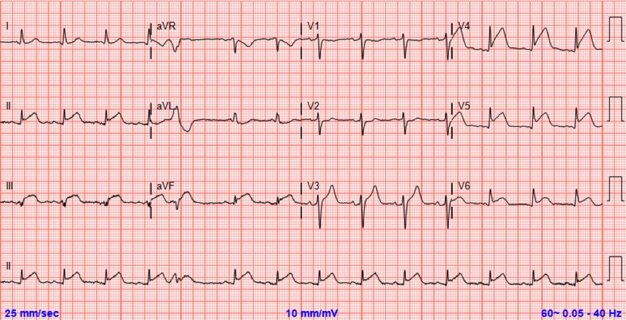 Cureus | Acute ST-Elevation Myocardial Infarction Caused by ...