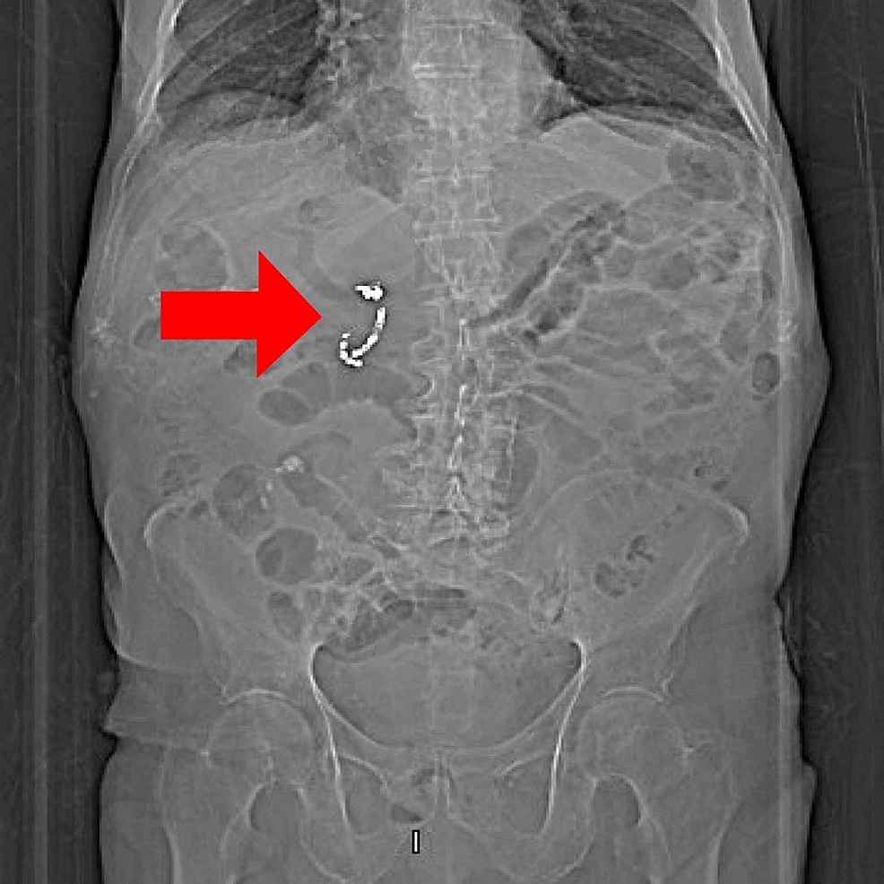Cureus Rare Complication of Interventional Radiologyguided Arterial