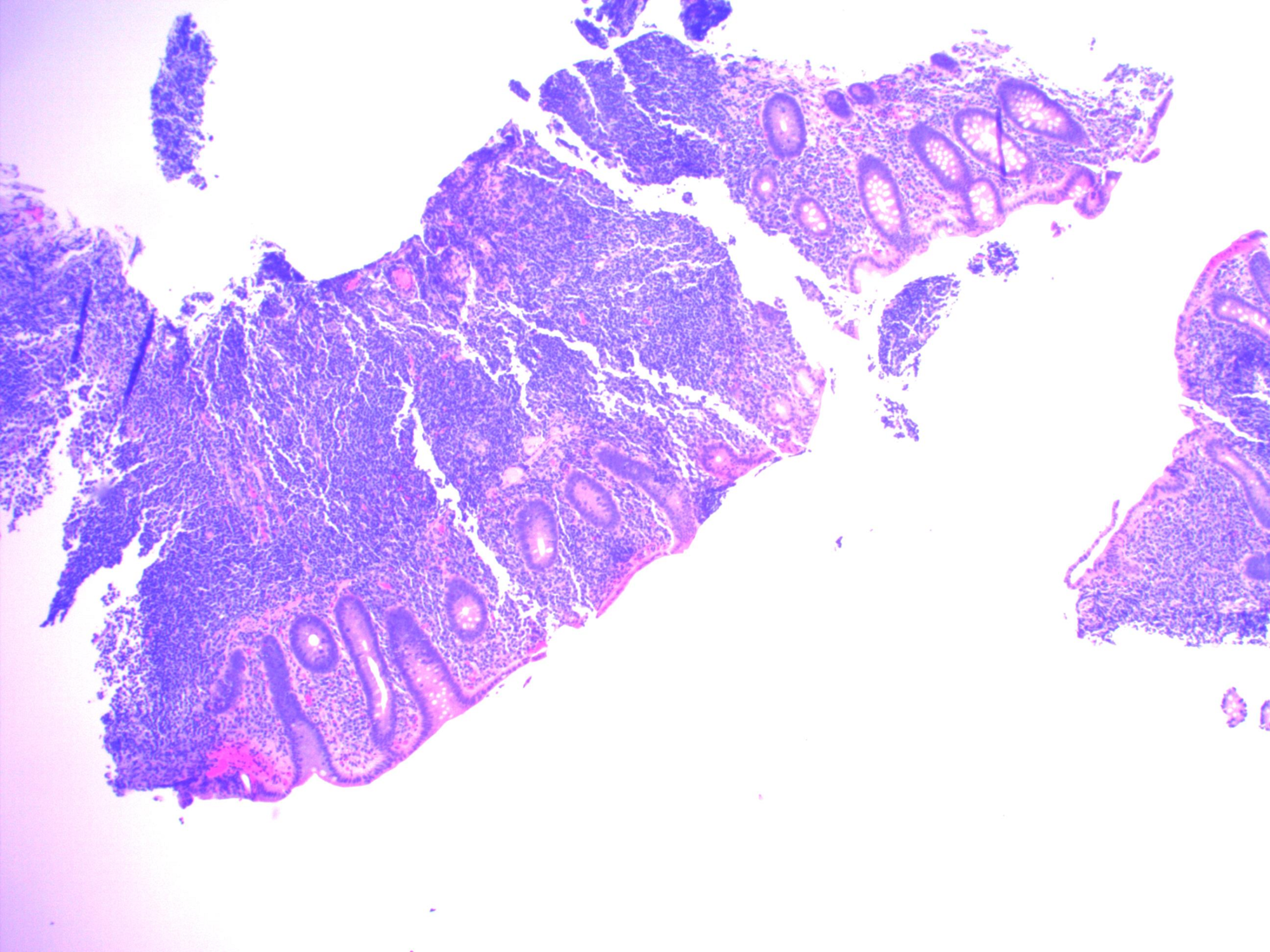 Cureus | Mucosa-associated Lymphoid Tissue Lymphoma of Colon: A Case ...