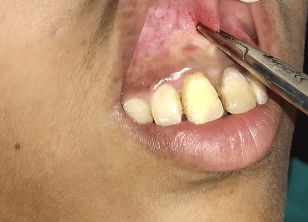 Maxillary Labial Double Frenum Frenectomy Using a Diode Laser A Case