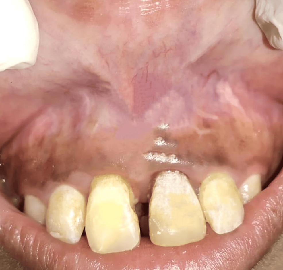 Maxillary Labial Double Frenum Frenectomy Using a Diode Laser A Case