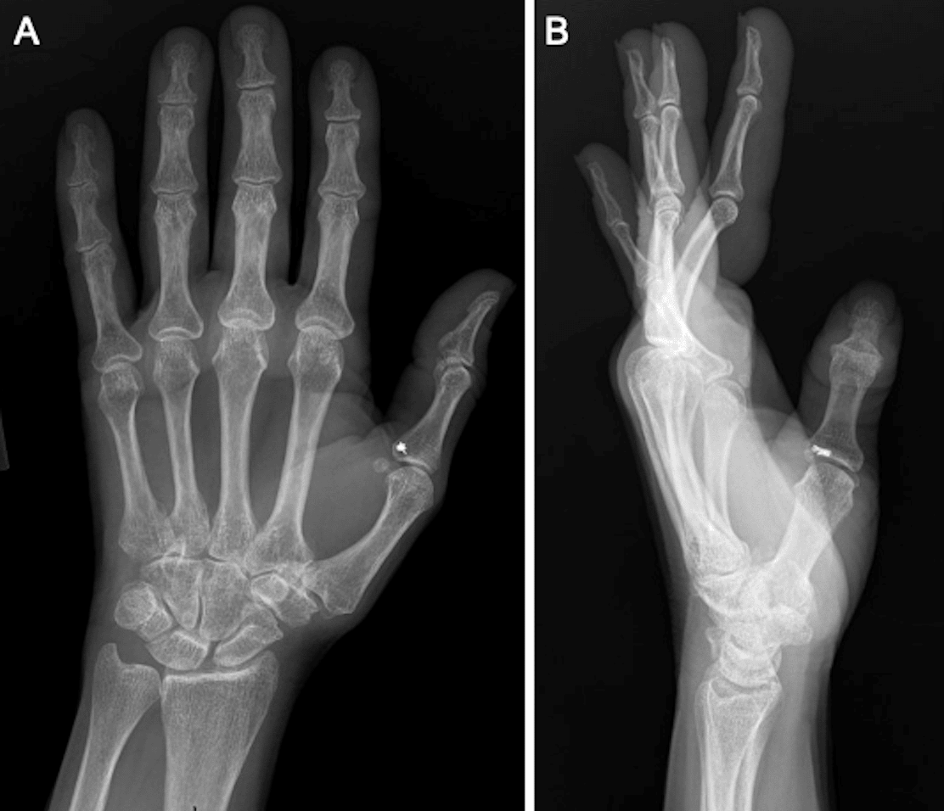 Cureus Nonabsorbable SutureLoaded Anchors for Finger Pulley