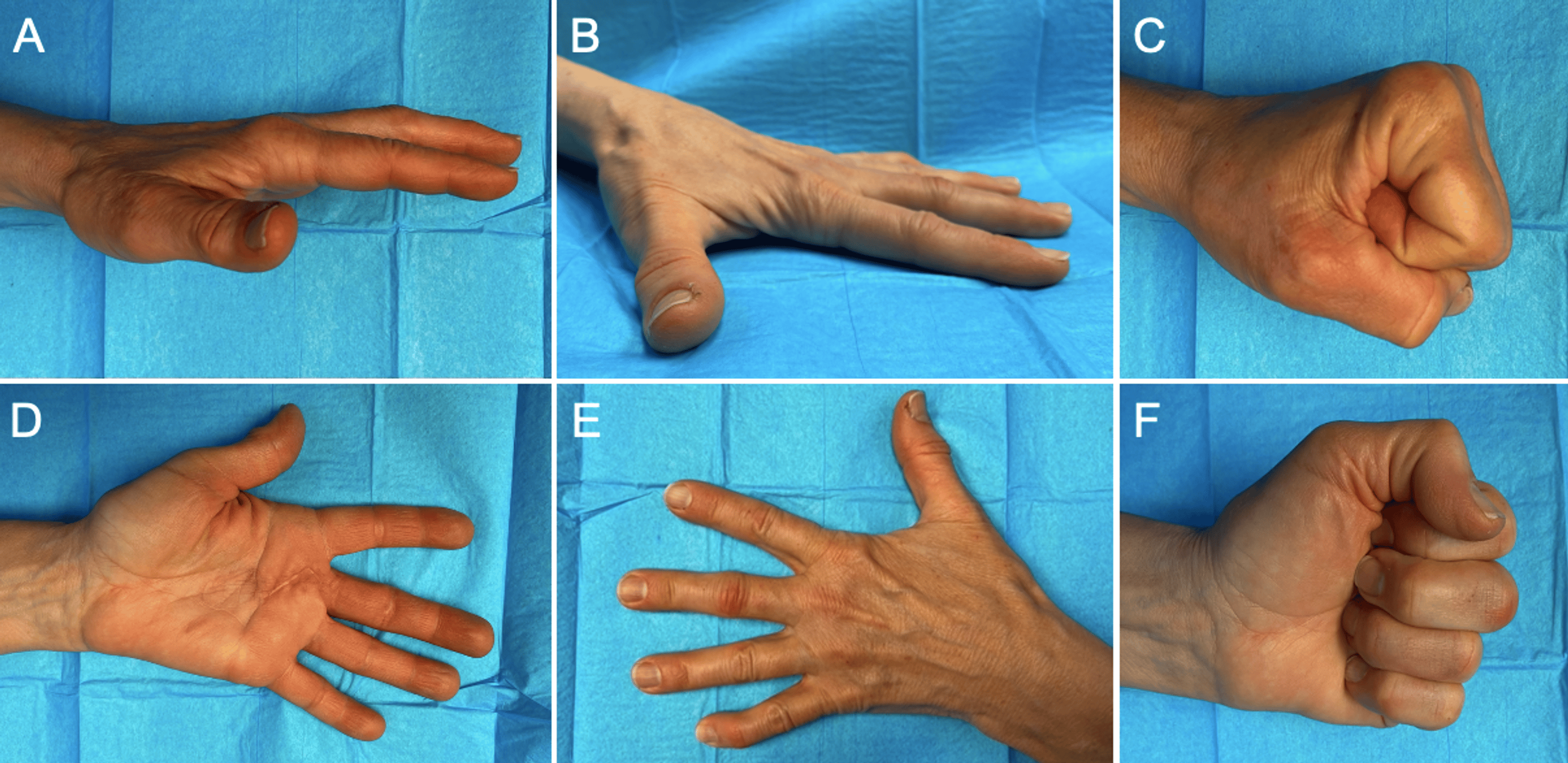 Cureus Nonabsorbable SutureLoaded Anchors for Finger Pulley