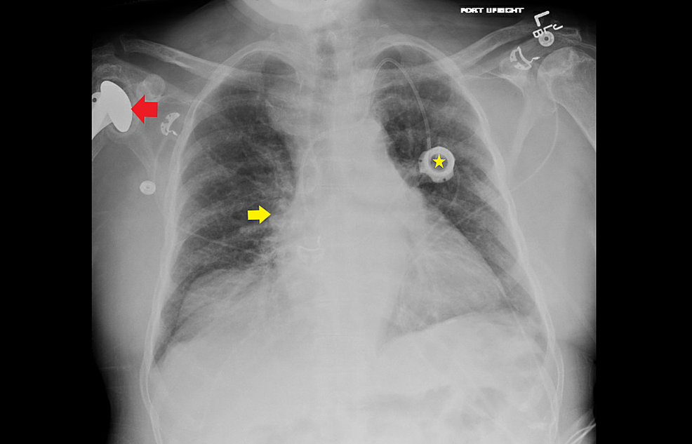 Cureus Brodie s Abscess Masquerading as Vaso occlusive Crisis in