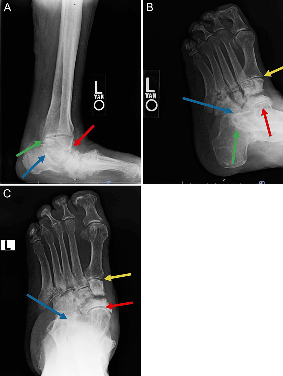 Cureus | Lepromatous Leprosy and Charcot Neuroarthropathy of Insensate Feet:  A Case Report | Article