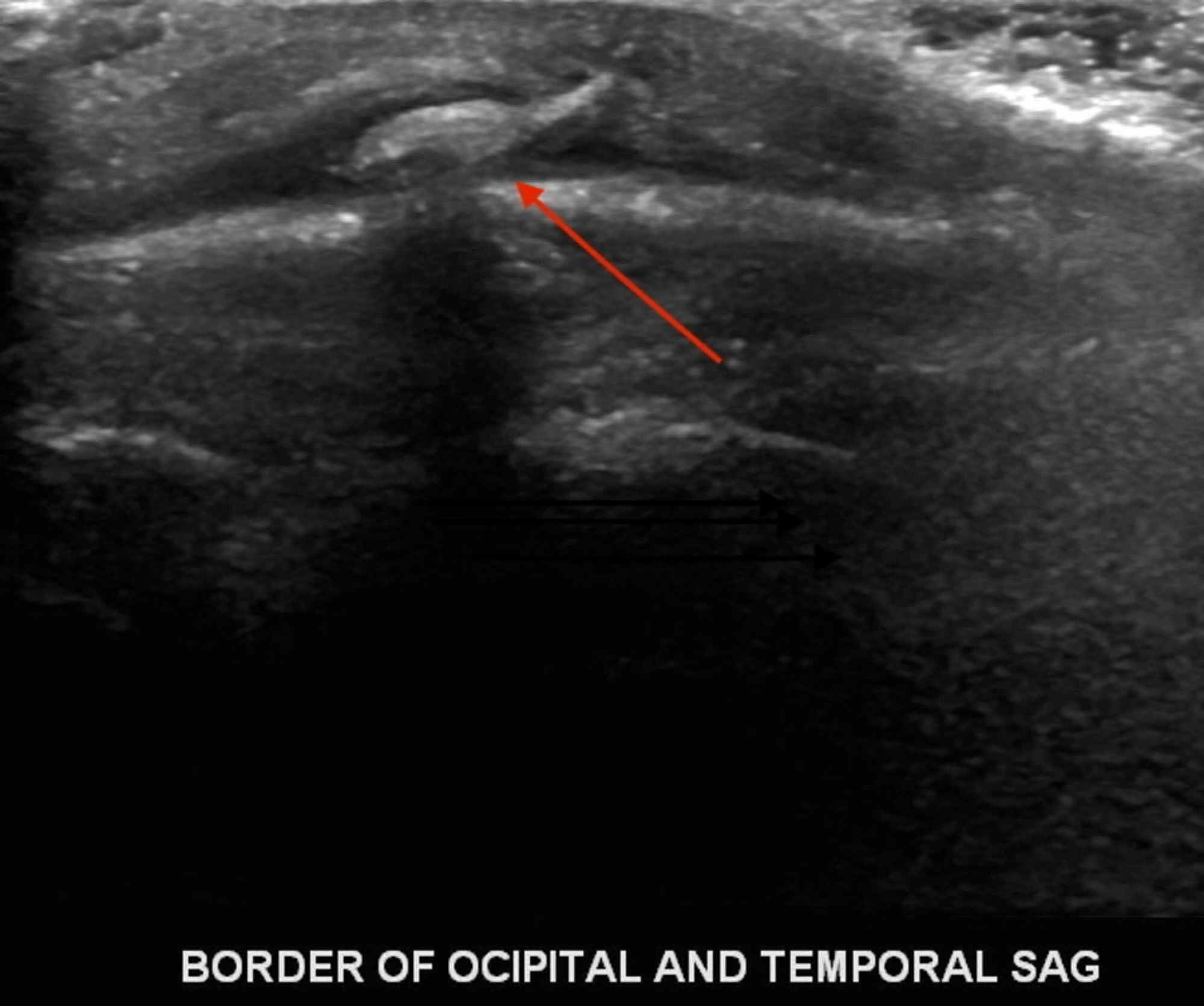 Cureus Cutaneous Myiasis An Unusual Cause of Posterior Auricular and
