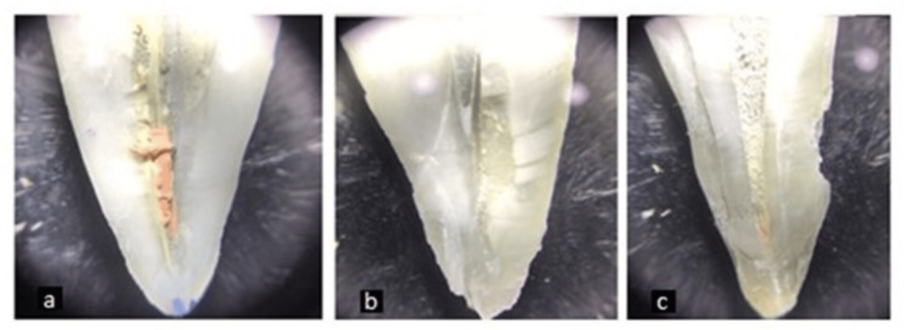 Comparative Evaluation of the Removal of Gutta Percha From the Root