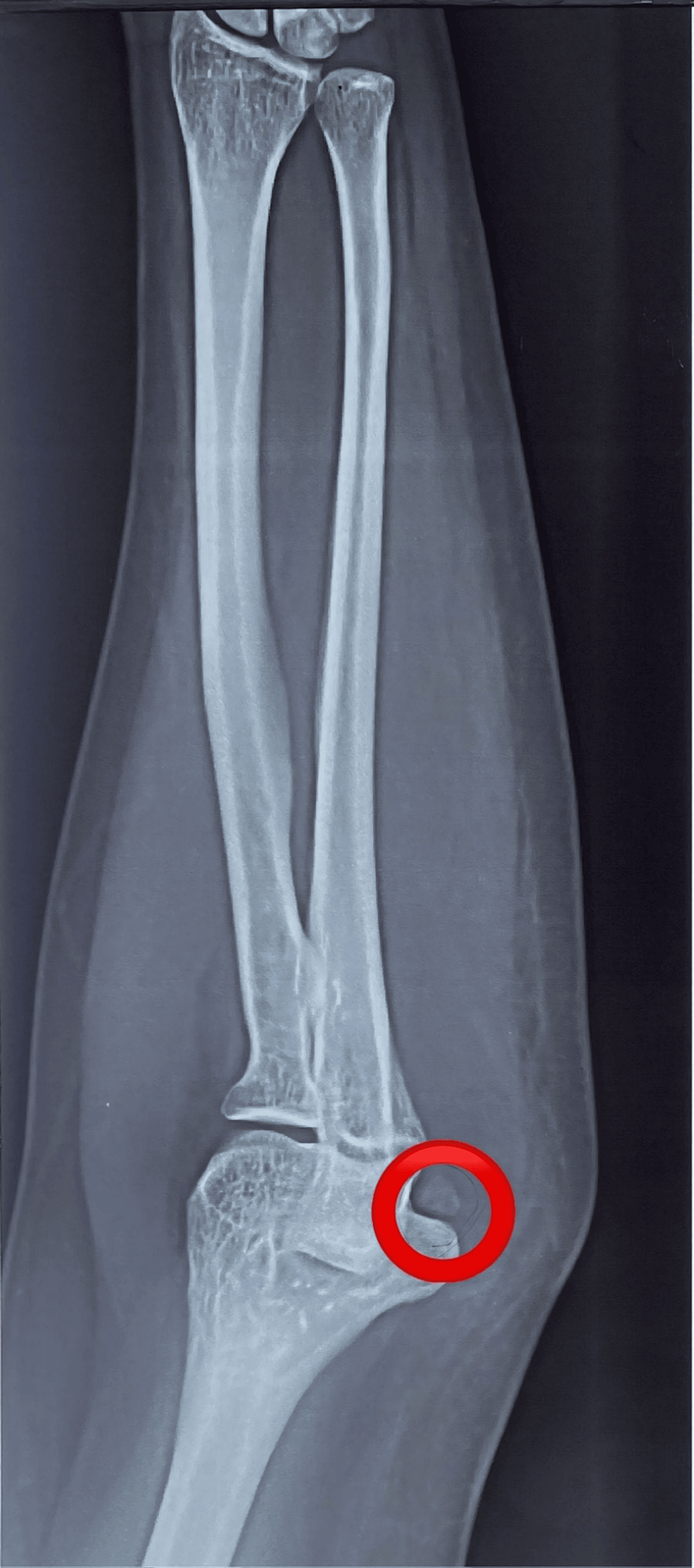 Os Subepicondylare Mediale in the Elbow: A Radiographic Case Report of a  Sesamoid Bone | Cureus, image size:986x2228