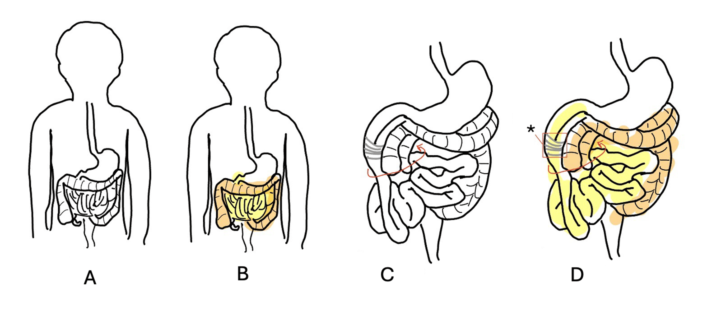 Gut Malrotation In A Human Cadaver Exploration Into The Prevention And Screening Of Undiagnosed