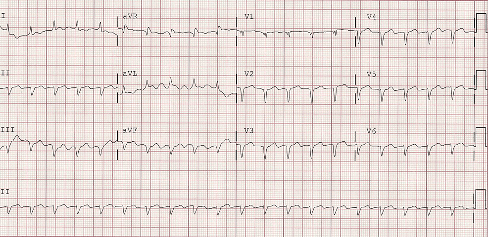 Transthyretin Cardiac Amyloidosis in an Elderly Male With Heart Failure ...