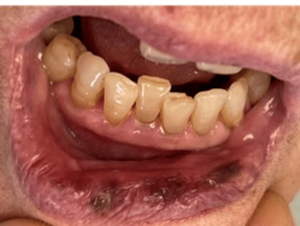 Citalopram-Induced Oral Melanotic Macules in a Female Patient and a Review  of the Literature